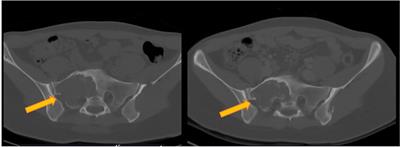 Rechallenge of denosumab in advanced giant cell tumor of the bone after atypical femur fracture: A case report and review of literature